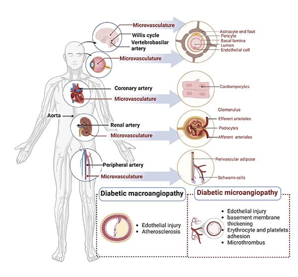 Figure 4. Micro- and macro-vascular complications of diabetes mellitus.