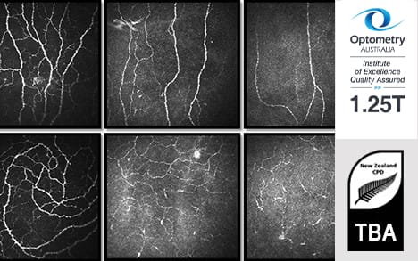 Diabetes associated dry eye disease summary content