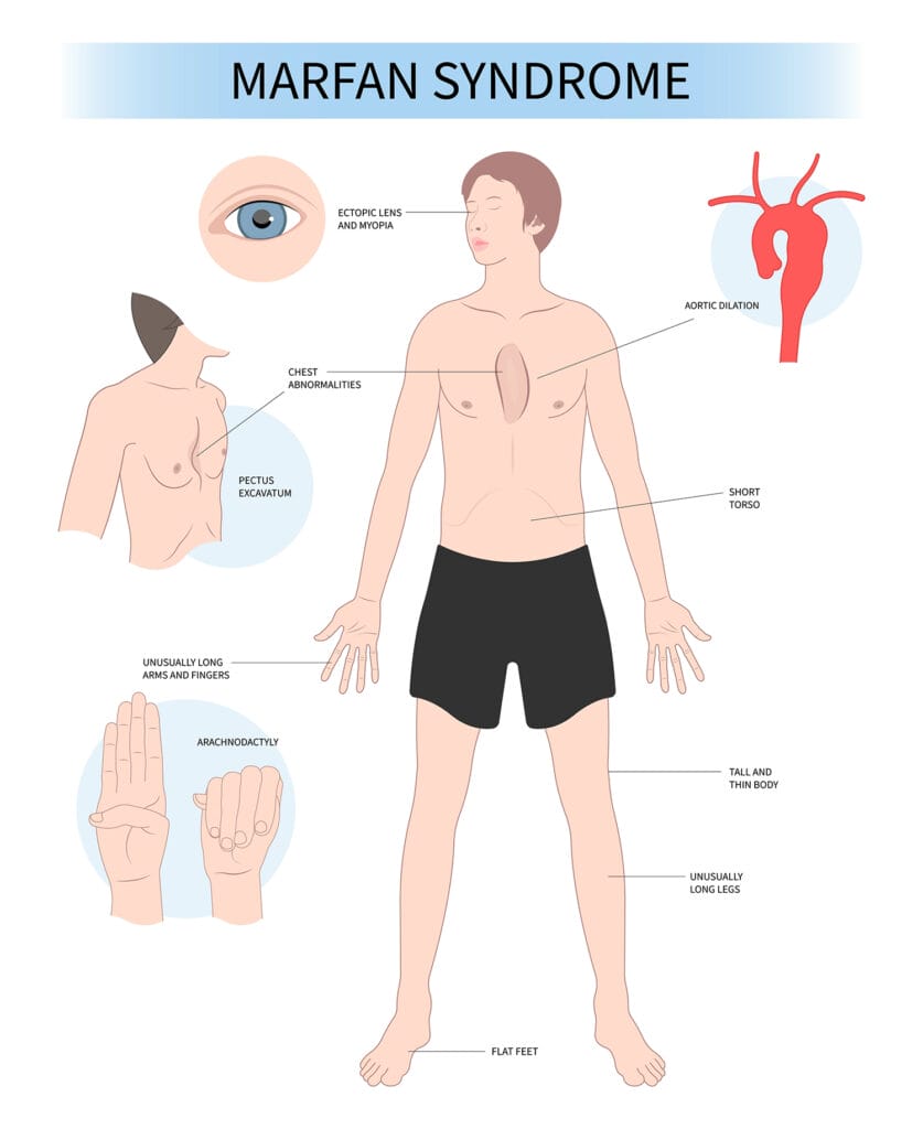 Graphic of the body showing common signs of Marfan syndrome, which can include syndromic myopia