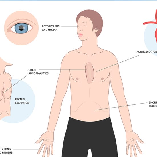 Syndromic myopia is a symptom of Marfan syndrome.