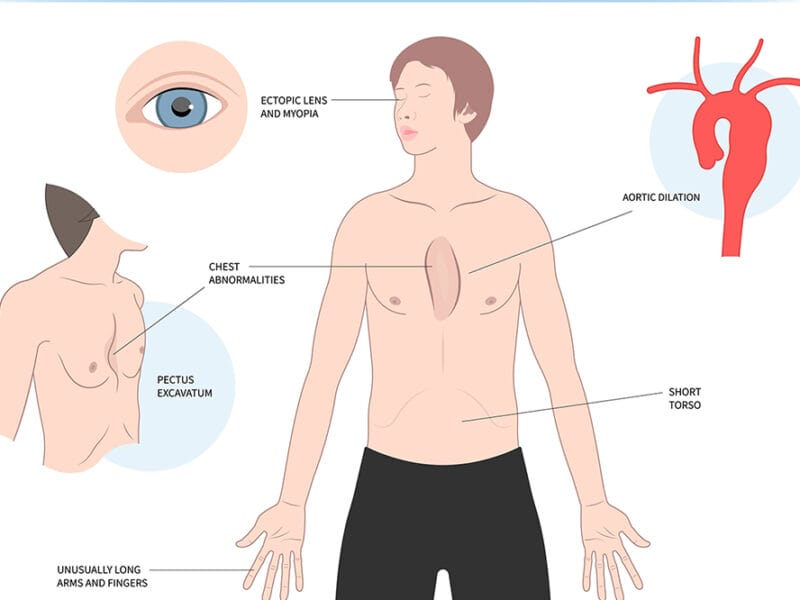 Syndromic myopia is a symptom of Marfan syndrome.