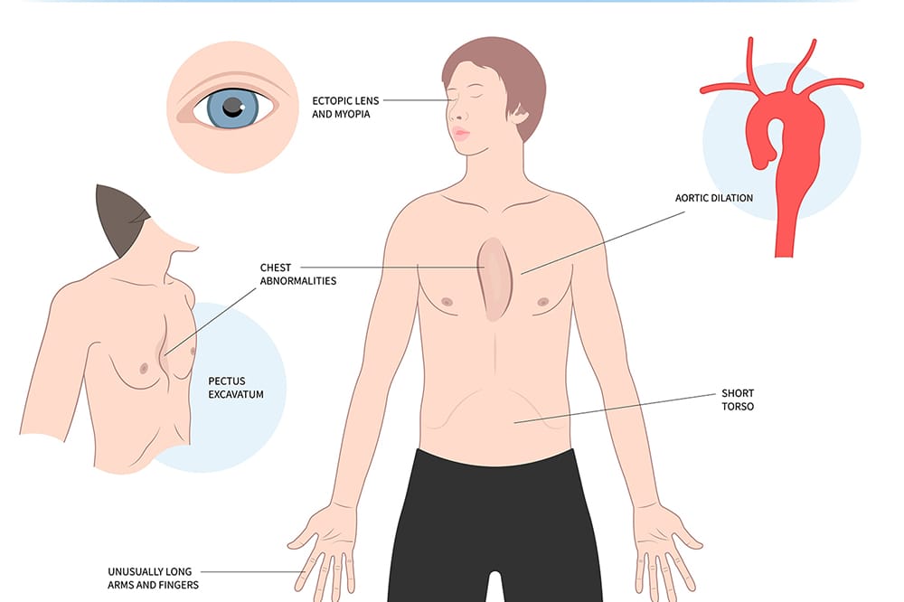 Syndromic myopia is a symptom of Marfan syndrome.