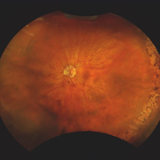 image from optomap screening