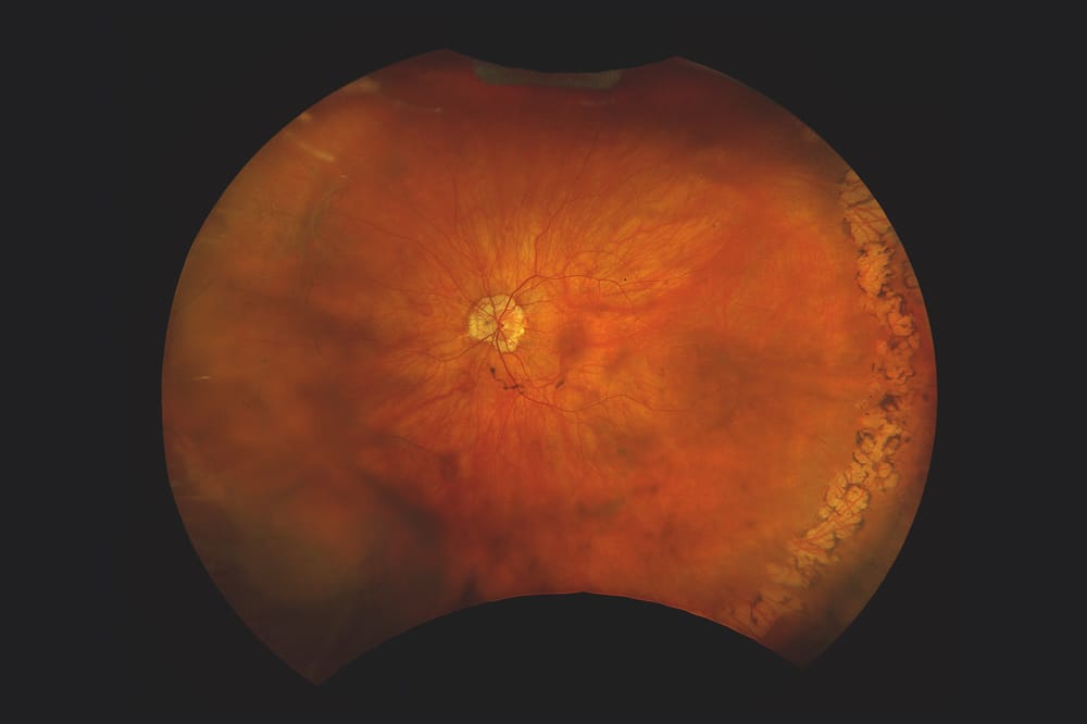 image from optomap screening