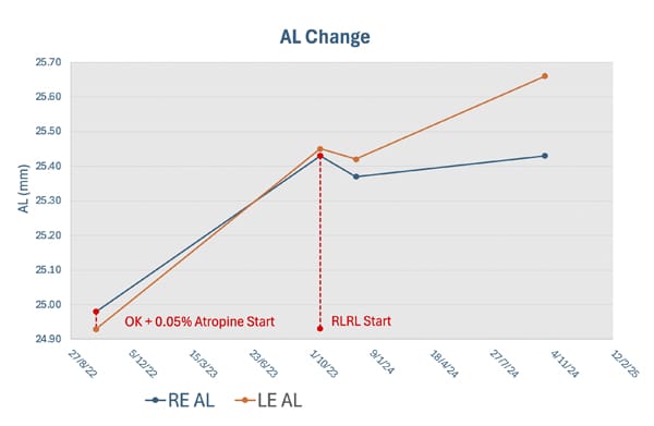 Figure 4. Axial length changes for a nine-year-old patient with high myopia, treated initially with OK and 0.05% atropine,before switching to RLRL.