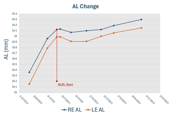 Figure 5. Axial length change of a real-world Chinese case study receiving RLRL treatment.