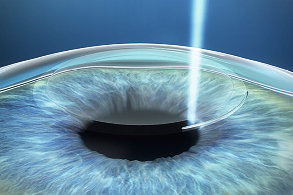 ZEISS small incision lenticule extraction