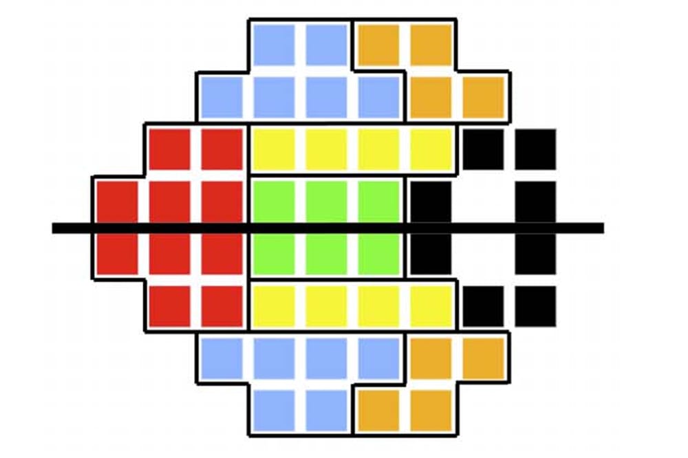 Visual Field Testing: A Guide to Interpreting Reports - mivision