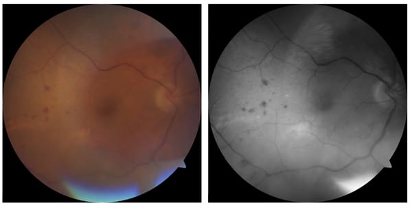 Figure 4. Diabetic retinopathy.