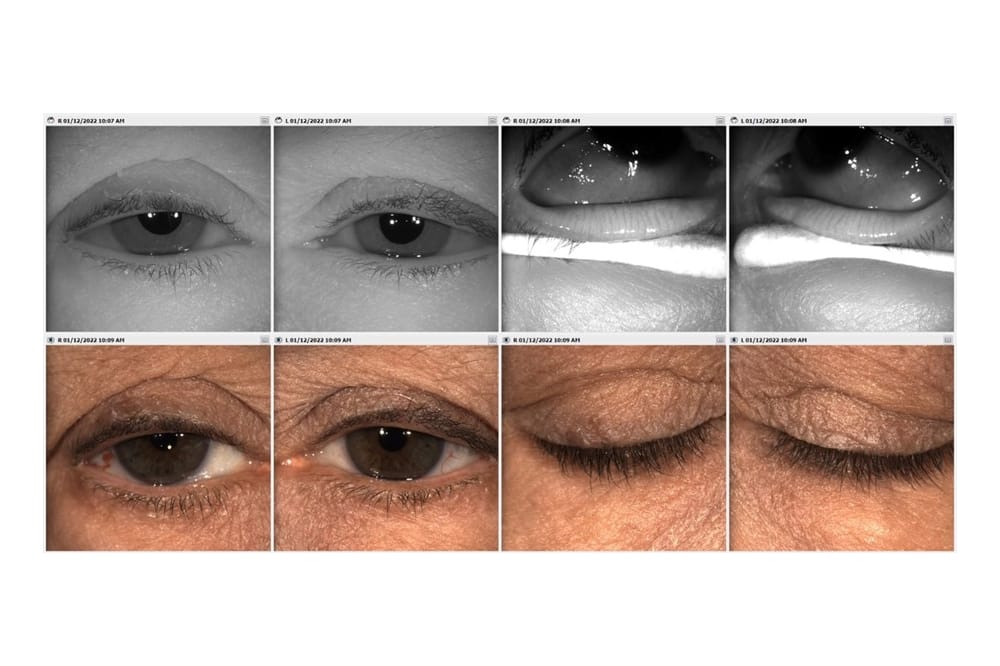 eyes before and after use of Medmont Meridia Professional