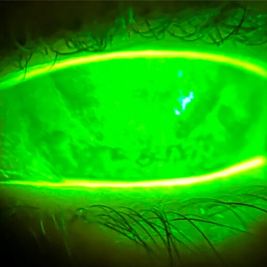 Figure 1. Ms Cahill’s left eye with severe corneal staining and keratoconjunctivitis sicca.