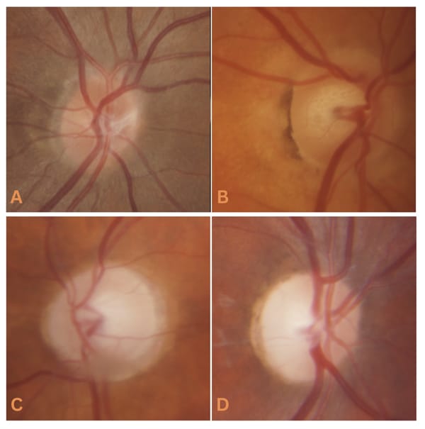 Figure 5. A) Healthy optic nerve head. B) Glaucoma suspect optic nerve head. C) Glaucomatous optic nerve head. D) Optic neuritis.