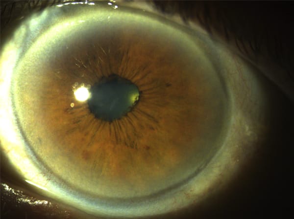 Figure 6. Cataract and small pupil with posterior synechiae.