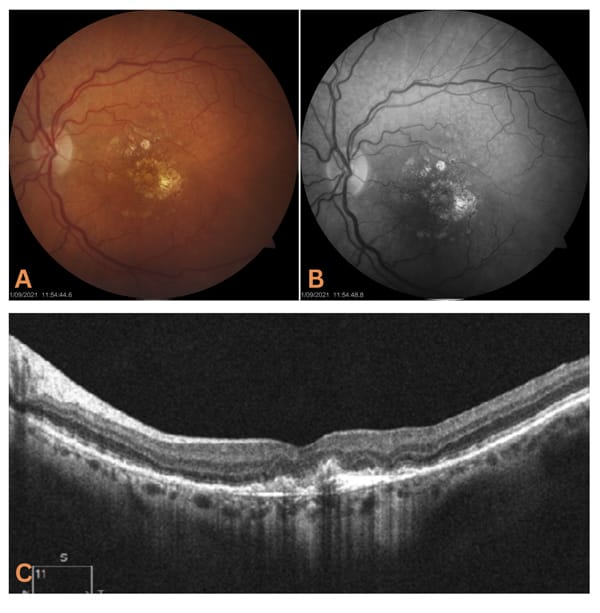 Figure 7. Fundus imaging of a patient with neovascular AMD and early geographic atrophy. A) Fundus photo. B) Red-free fundus photo. C) OCT cross section. 