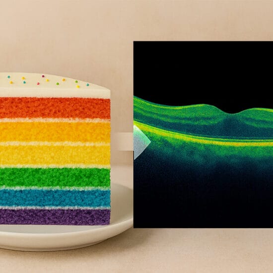 Slice of layer cake next to diagnostic eye scan to show patient analogy.