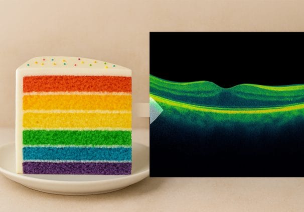 Slice of layer cake next to diagnostic eye scan to show patient analogy.