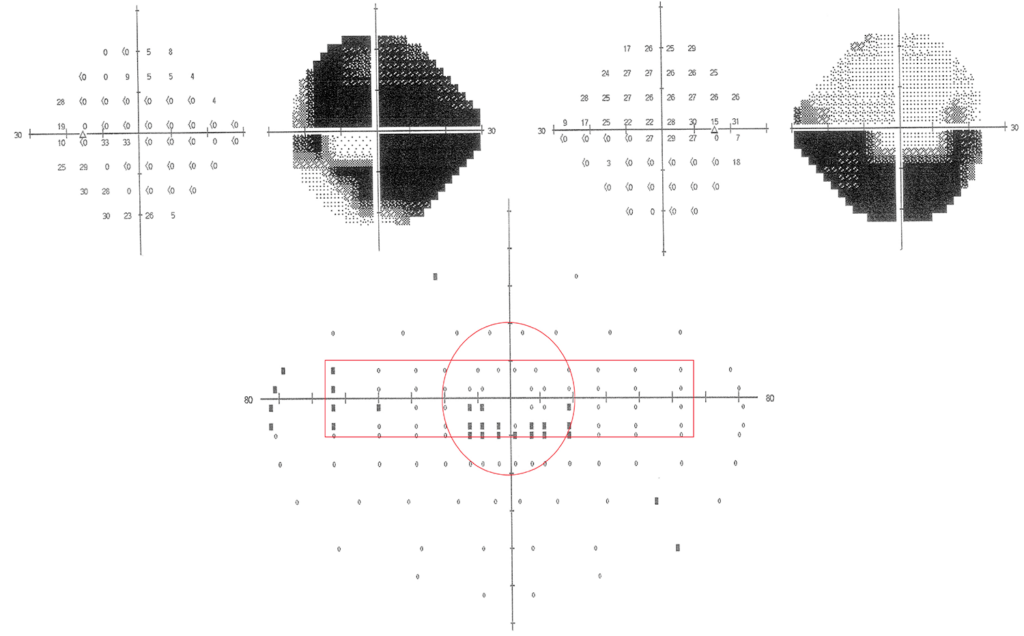 Figure 1. Example of a driver with glaucomatous field loss with the fitness to drive criteria applied.