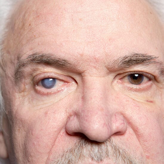 man with complex cataract condition