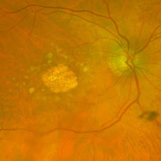 Image showing dry AMD