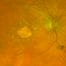 Image showing dry AMD