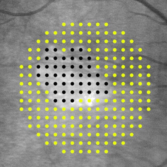 Defect mapping microperimitery uses single suprathreshold stimuli presentations at 208 points, in eyes with geographic atrophy.