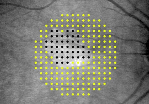 Defect mapping microperimitery uses single suprathreshold stimuli presentations at 208 points, in eyes with geographic atrophy.