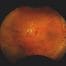 Image captured using optomap ultra-widefield device